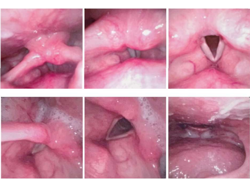 Videonazofaringoscop EF20 cu monitor VS100B 