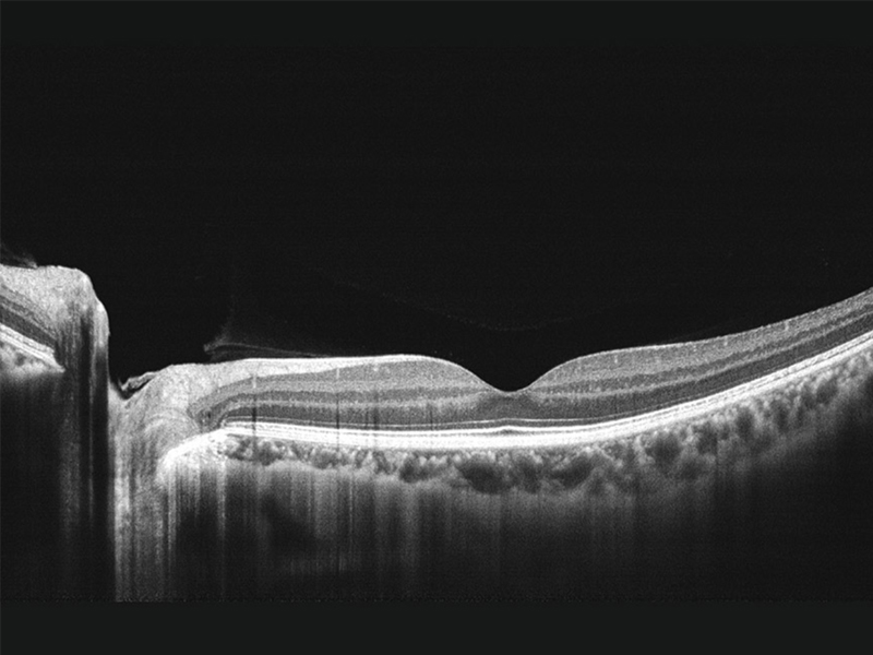 Tomograf in coerenta optica MOCEAN 4000 