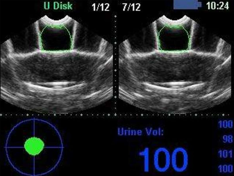 Scanner vezica urinara BVT02 