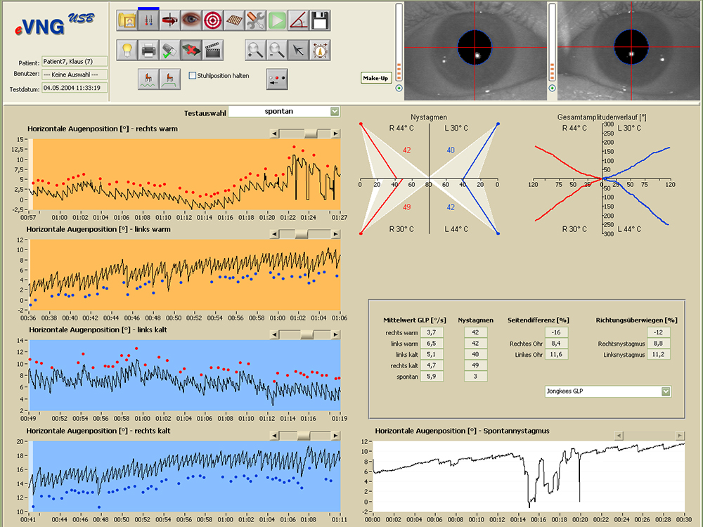 Sistem eVNG+eHIT (Videonistagmograf cu Head Impulse Test) 