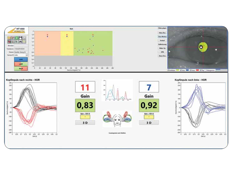 Sistem VNG+HIT (Videonistagmograf cu Head Impulse Test) 