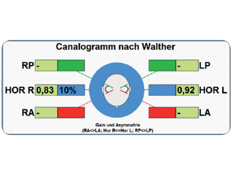 Sistem VNG+HIT (Videonistagmograf cu Head Impulse Test) 